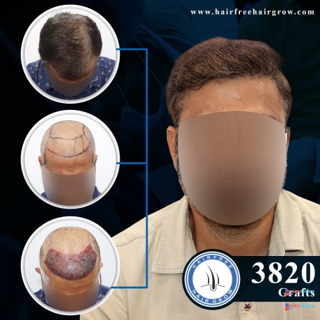 hair-transplant-clinic-in-chattogram-hair-free-hair-grow-bangladesh-big-1